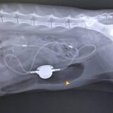 猫の尿管結石による尿管閉塞