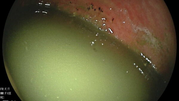 犬　急性嘔吐　異物による腸閉塞　内科治療のみ