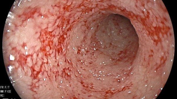 リンパ球形質細胞性胃腸炎　慢性嘔吐　内視鏡生検　猫
