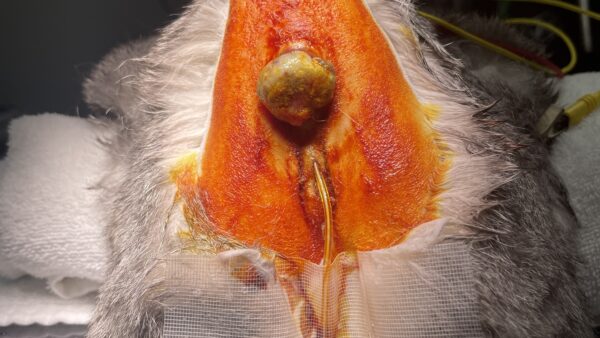 直腸腫瘍　高悪性度未分化肉腫