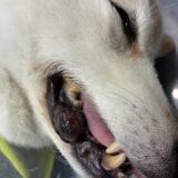 口腔内悪性黒色腫　メラノーマ　摘出手術
