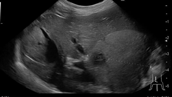 犬　肝臓腫瘍　肝細胞癌　摘出手術