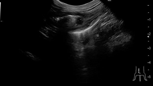 猫の腸腫瘍　摘出手術　高分化型リンパ腫　