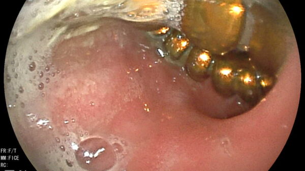 胃内異物　内視鏡　摘出