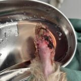 指を残して腫瘍摘出手術　指の腫瘍　指切断