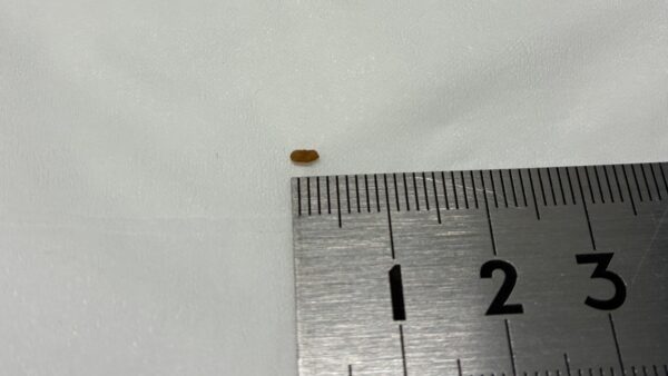 尿管閉塞　尿管結石　摘出手術